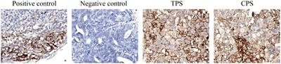 Case Report: Overcoming challenges in pancreatic cancer with liver metastases: a personalized therapeutic odyssey of TACE, ablation, and immunotherapy